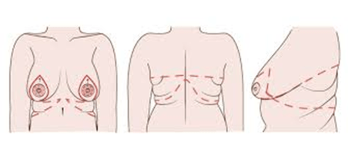 breast lift surgery dubai - Prof Dr. Robert Hierner
